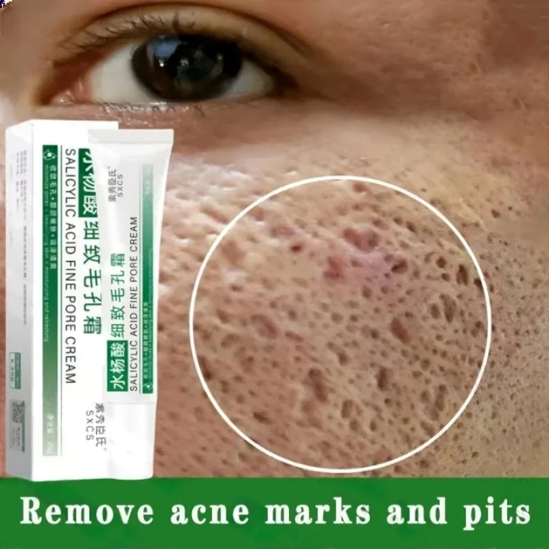 Salicylsäure Poren Clearing Cr – Salicylic Acid Blackhead Remover Bewertung und Preis