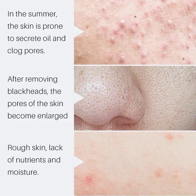 Salicylsäure Porenverkleinernd – Salicylic Acid Blackhead Remover Bewertung und Preis